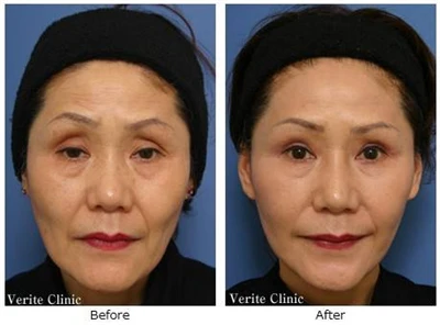 Cirugía de estiramiento facial para pacientes del sudeste asiático